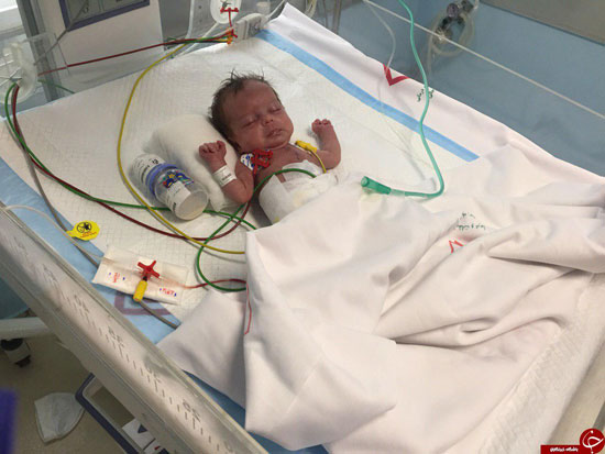 سنگین‌ترین جراحی قلب بر روی نوزاد ١۴٠٠گرمی