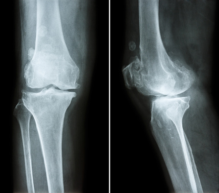 شکستگی تنشی استخوان چیست؟