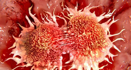 احتمال ابتلای مردان به سرطان سینه
