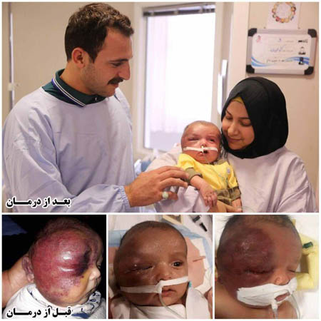 درمان سندروم نادر و کشنده کودک عراقی در مشهد